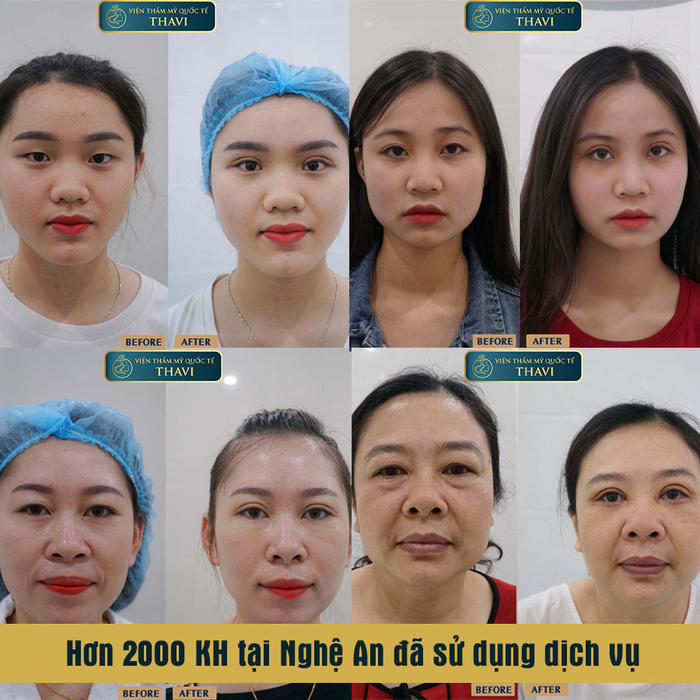 Viện Thẩm Mỹ Quốc Tế Thavi - Bộ sưu tập hình ảnh đẳng cấp