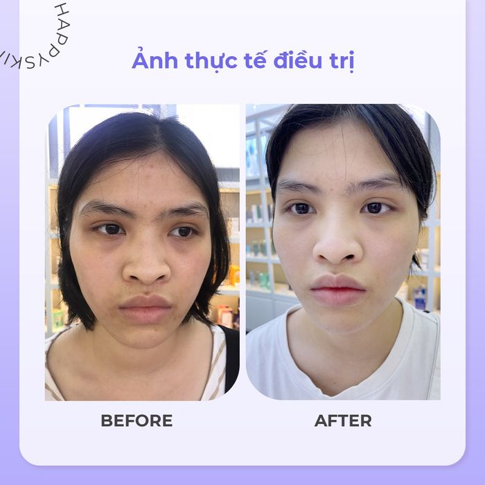 Hình ảnh trị liệu chuyên sâu tại Happy Skin Beauty Clinic