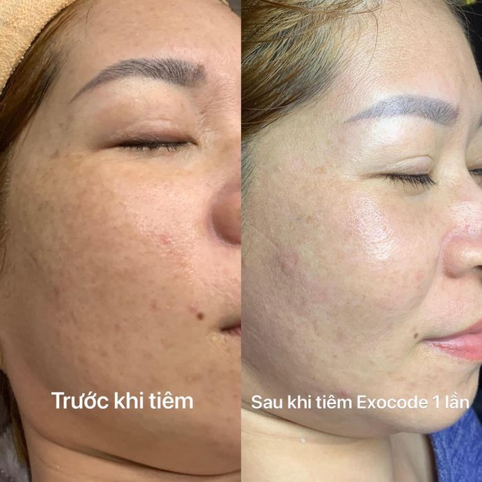 Quy trình trị nám cao cấp với công nghệ EXOCODE tại IMiss Beauty & Spa