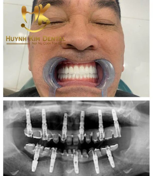 Hình ảnh thực tế tại Nha khoa Huỳnh Kim