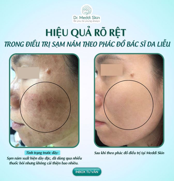 Hình ảnh liệu trình trị nám cao cấp tại Meddi Skin