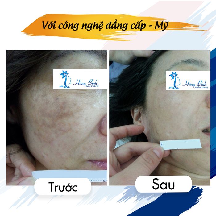 Hệ thống máy móc tân tiến tại Da liễu thẩm mỹ Hùng Bình - Đẳng cấp dịch vụ đạt chuẩn quốc tế