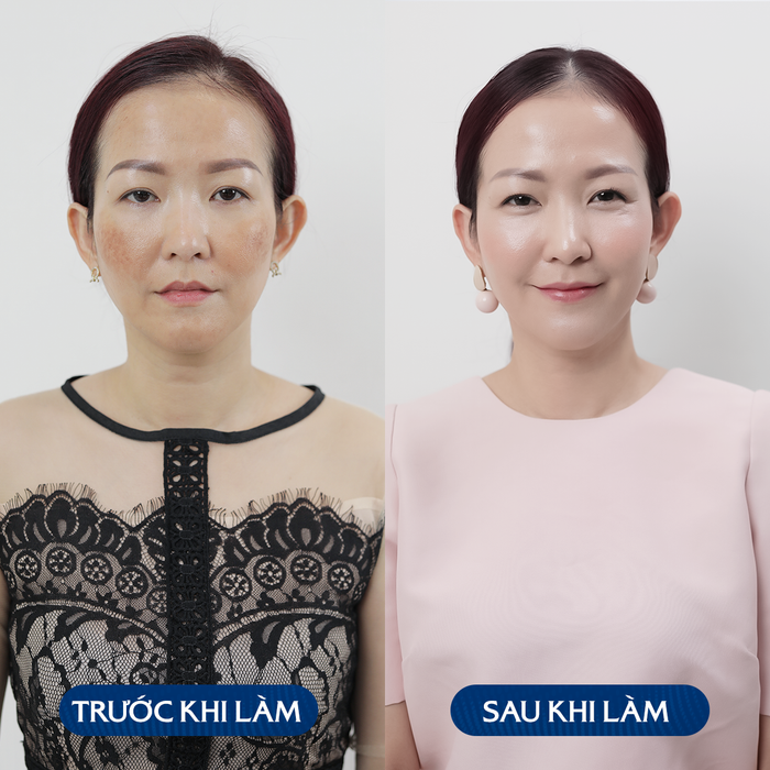 Hình ảnh quy trình trị nám chuyên nghiệp tại Aqua Clinic