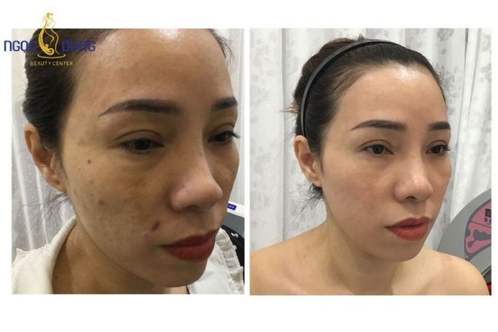 Hình ảnh liệu trình trị nám chuyên sâu tại Ngoc Dung Beauty