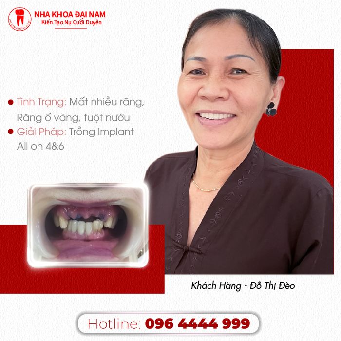 Hình ảnh quy trình trồng răng chuẩn quốc tế tại Nha Khoa Đại Nam