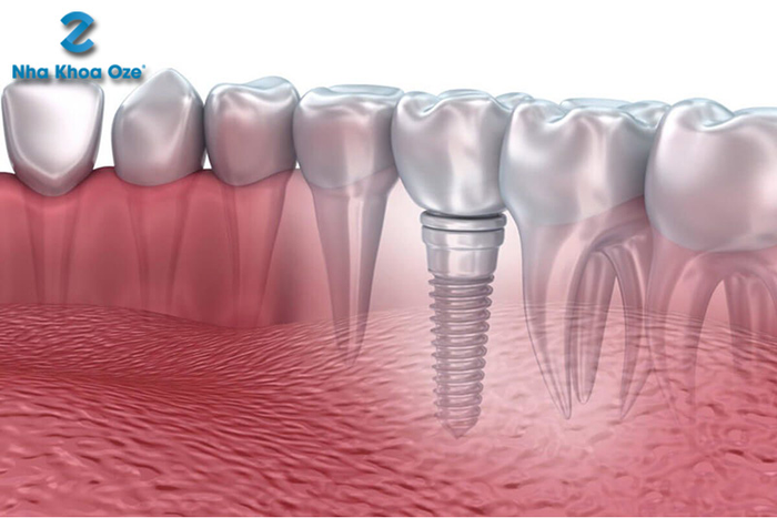 Hình ảnh quy trình trồng răng Implant chuyên nghiệp tại Nha khoa OZE