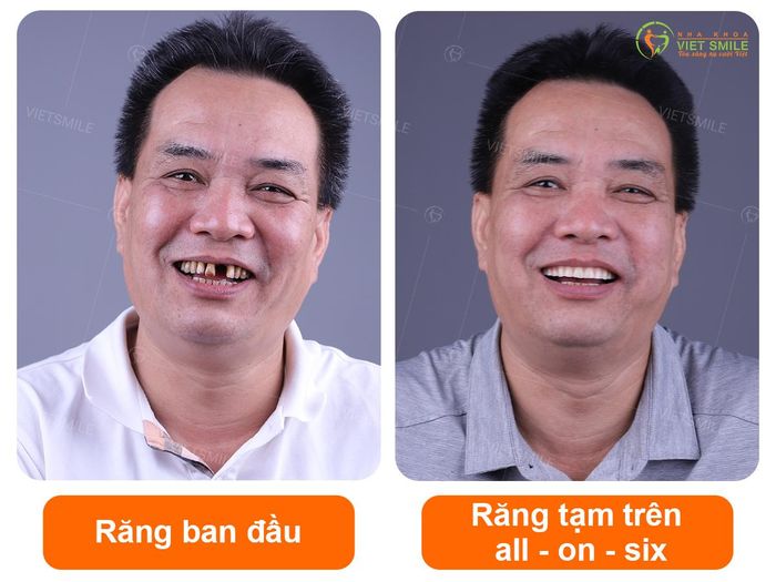 Hình ảnh quy trình cấy ghép Implant chuyên nghiệp tại Việt Smile