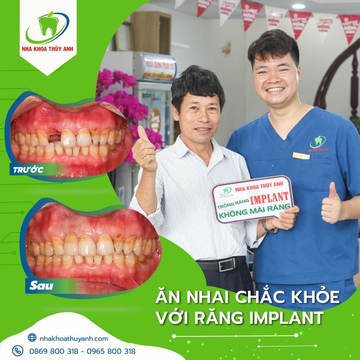 Hình ảnh quy trình cấy ghép Implant công nghệ cao tại Nha khoa Thùy Anh