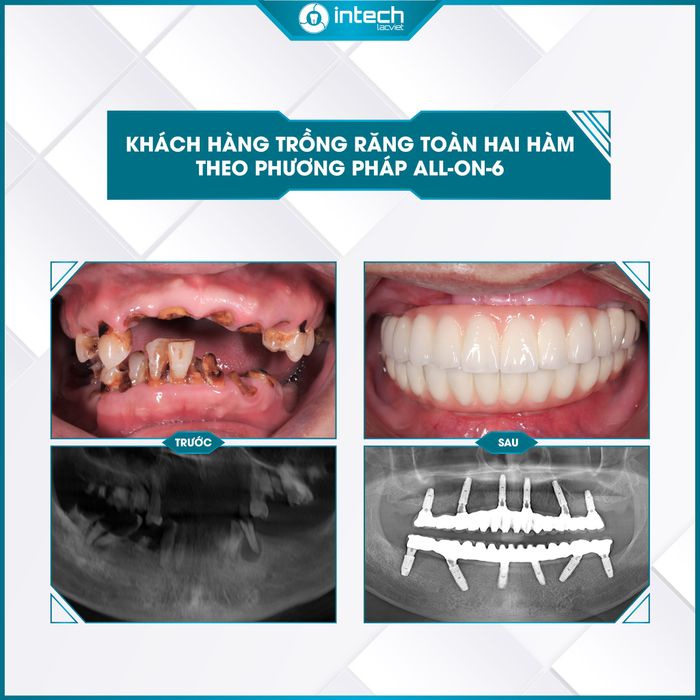 Hình ảnh quy trình cấy ghép Implant công nghệ cao tại Lạc Việt Intech