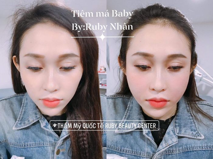 Viện Thẩm Mỹ Quốc Tế RuBy ảnh 2