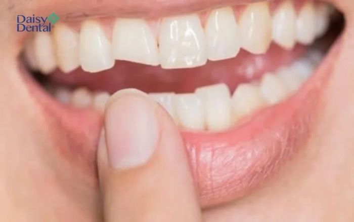 Hình ảnh thực tế quy trình dán sứ tại DAISY