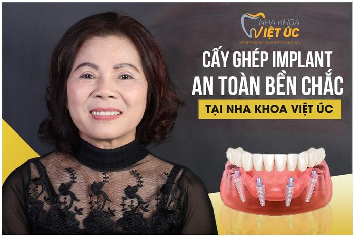 Hình ảnh quy trình cấy ghép Implant chuyên nghiệp tại Việt Úc