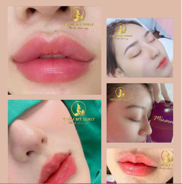 Hình ảnh kết quả thực tế tại Thẩm Mỹ Senly
