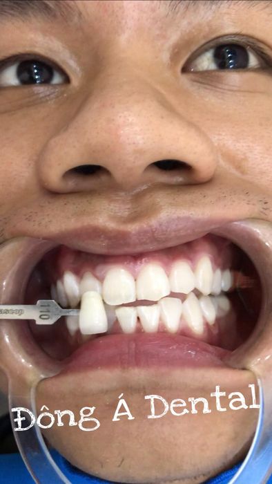 Hình ảnh quy trình tẩy trắng công nghệ cao tại Nha Khoa Đông Á