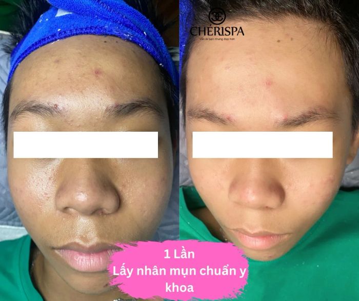 Quy trình trị liệu chuyên nghiệp tại Chérispa Quảng Ngãi (Ảnh 2)