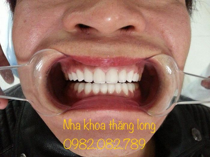Hình ảnh thực tế tại Nha khoa Thăng Long Hà Nam