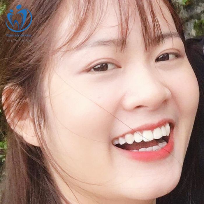 Hình ảnh minh họa công nghệ Laser Whitening tại Nha Khoa Toàn Mỹ
