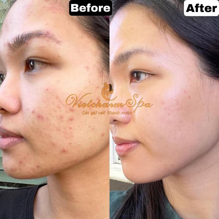 Quy trình trị liệu chuyên nghiệp tại VietCharm Spa & Clinic