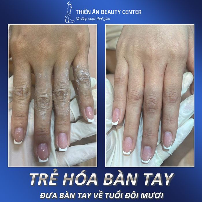 Hình ảnh thực tế quy trình làm đẹp công nghệ cao tại Thiên Ân