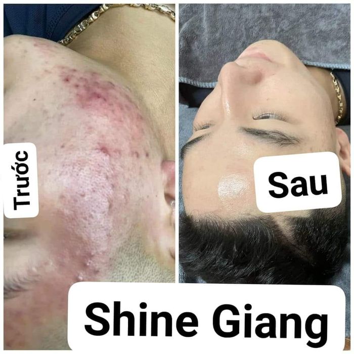 Hình ảnh liệu trình trị mụn chuyên nghiệp tại Shine Giang