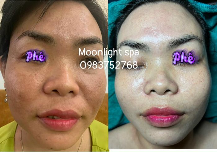 Hình ảnh liệu trình trị nám chuyên nghiệp tại MoonLight Spa