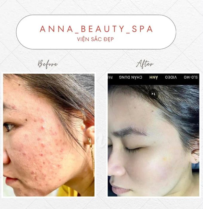 Hình ảnh liệu trình trị mụn chuyên sâu tại ANNA SPA