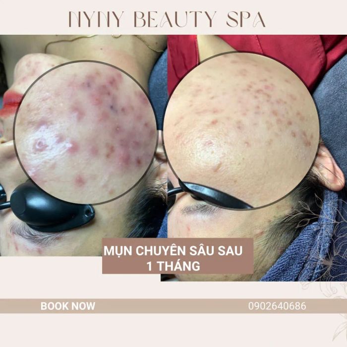 Hình ảnh liệu trình trị mụn chuyên sâu tại NyNy Beauty Spa