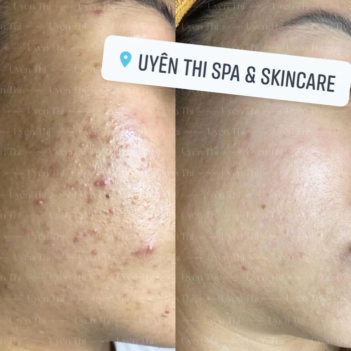 Hình ảnh liệu trình trị mụn công nghệ cao tại Uyên Thi Spa & Skincare