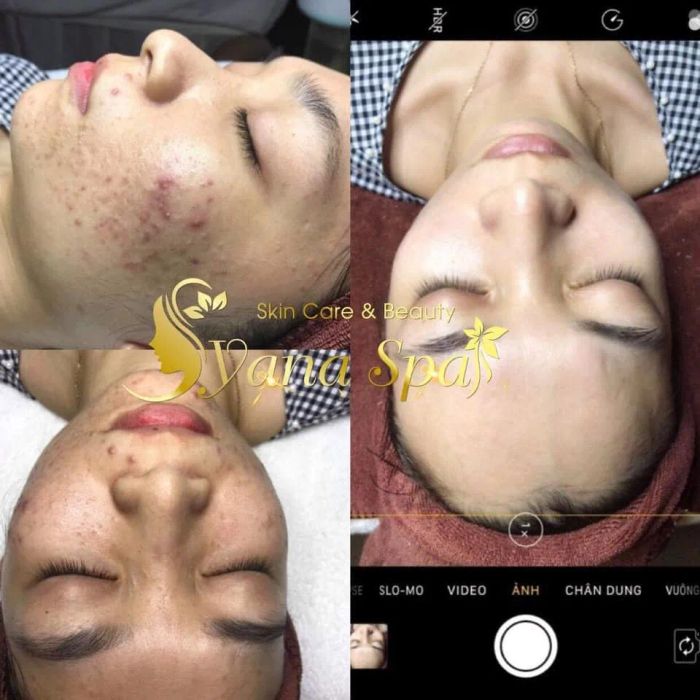 Hình ảnh liệu trình chăm sóc da tại YANA Clinic & Spa