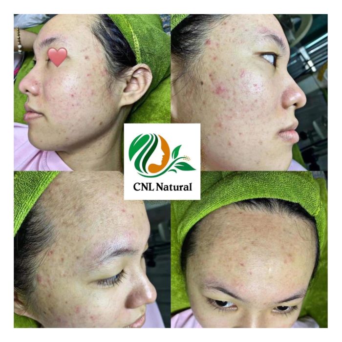 Hình ảnh liệu trình điều trị tại Hoàng Kim Beauty & Spa