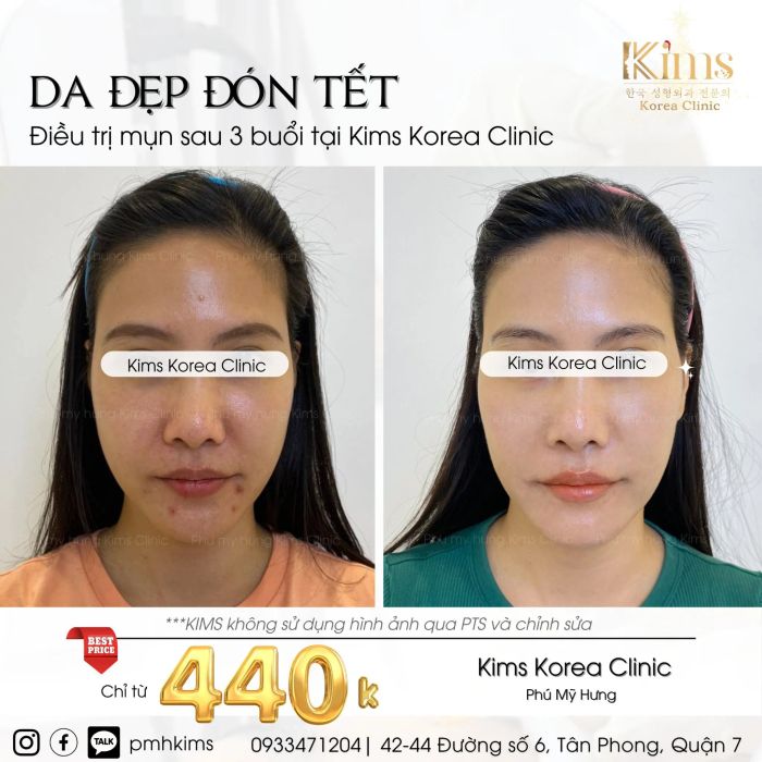 Quy trình trị mụn chuyên nghiệp tại Kims Clinic