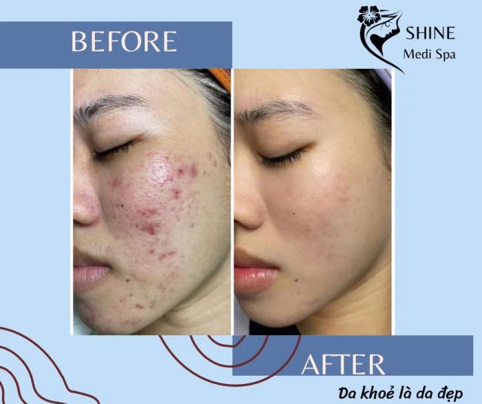 Không gian điều trị mụn chuyên nghiệp tại Shine Medi & Spa