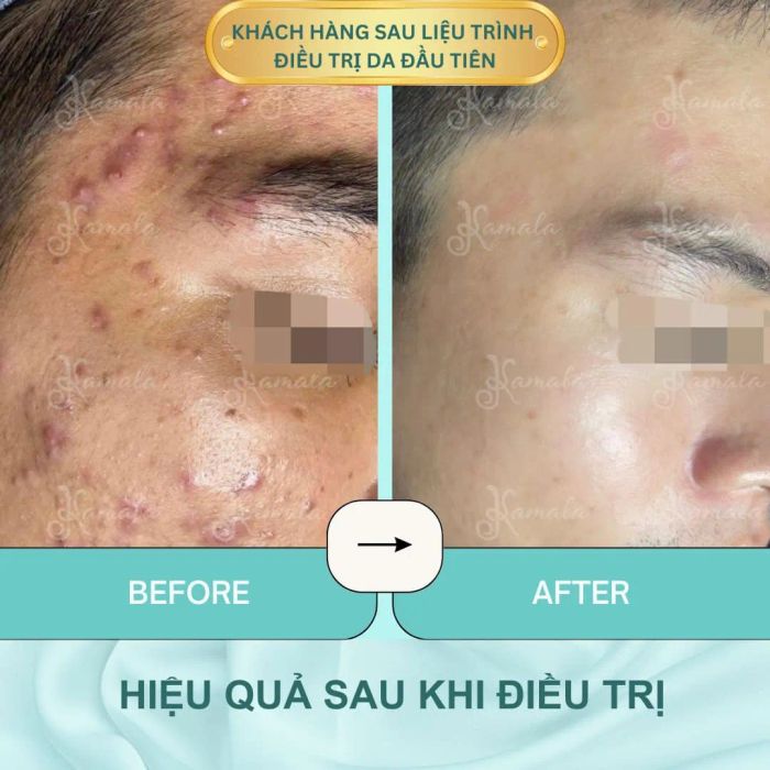 Quy trình trị mụn chuẩn Nhật tại Kamala Beauty & Clinic