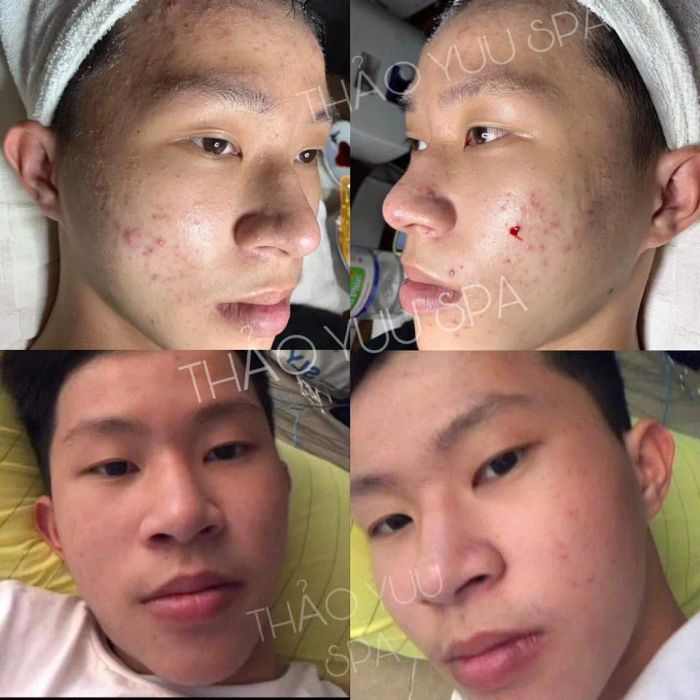 Quy trình trị mụn chuyên nghiệp tại Thảo Yuu Beauty & Spa