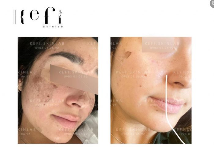 Kefi Skinlab - Địa chỉ vàng cho làn da không tì vết