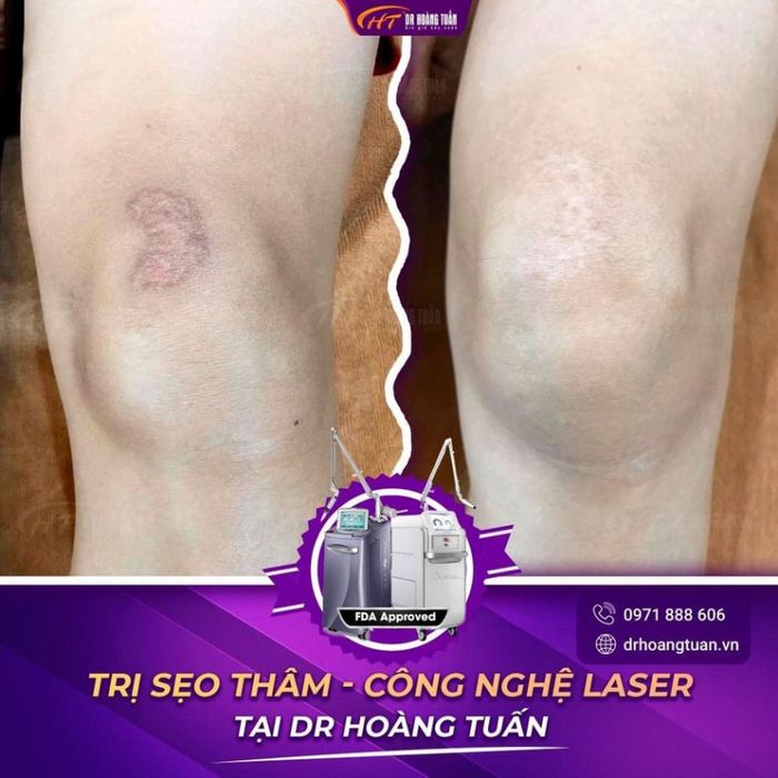 Quy trình trị thâm chuẩn y khoa tại Thẩm mỹ Hoàng Tuấn