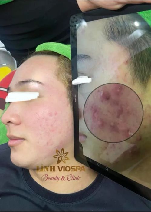 Quy trình trị liệu chuyên nghiệp tại Thẩm Mỹ Linh Viospa