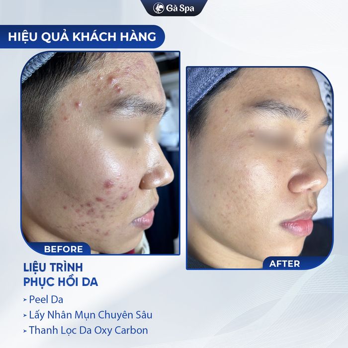 Quy trình trị mụn chuyên nghiệp tại Gà Spa