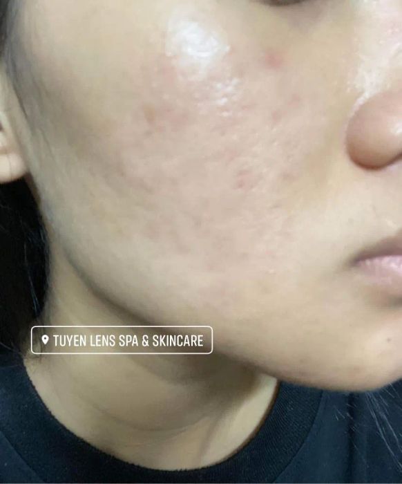 Quy trình điều trị chuyên nghiệp tại TuyenLens Spa & Skincare