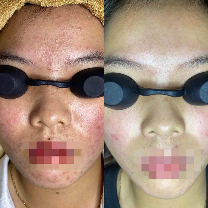 Quy trình trị mụn chuyên nghiệp tại DK Spa & Clinic