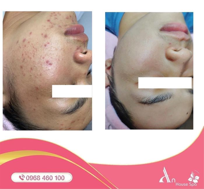 Liệu trình trị liệu độc đáo tại An House Spa