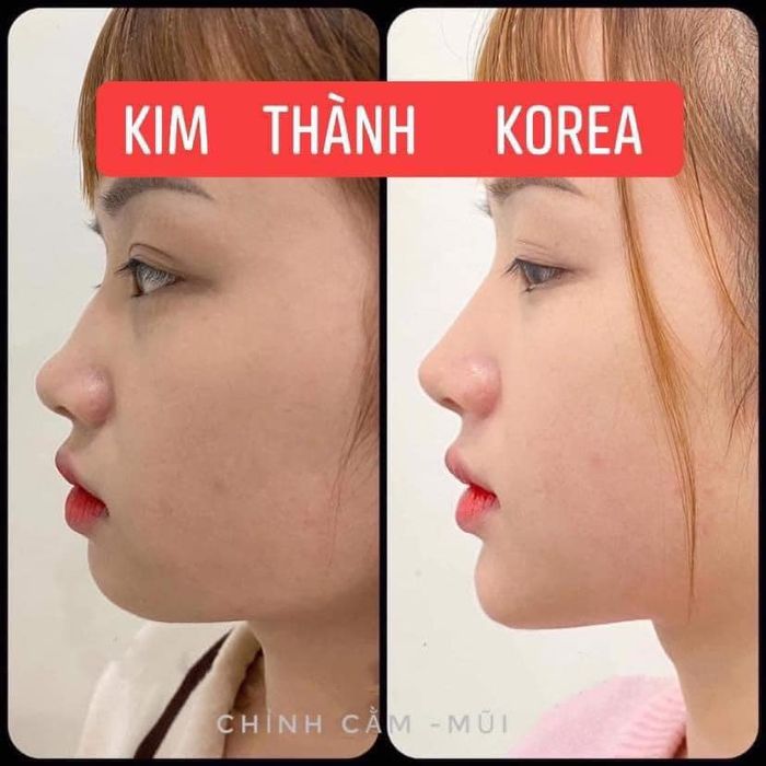 Hình ảnh thực tế quy trình tiêm filler tại Thẩm Mỹ Viện Kim Thành (ảnh 2)
