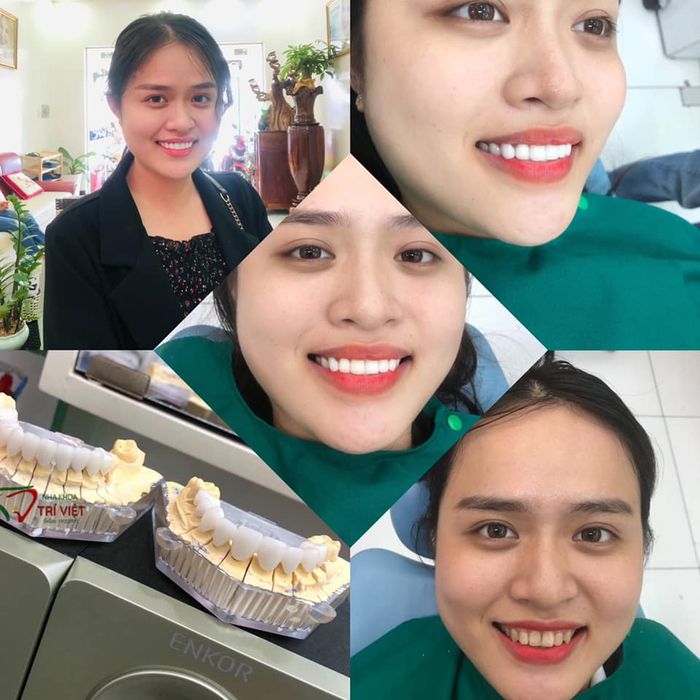 Hình ảnh thực tế quy trình bọc răng sứ tại Nha khoa Trí Việt
