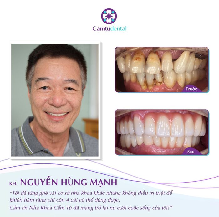 Hình ảnh thực tế quy trình điều trị tại Nha Khoa Cẩm Tú