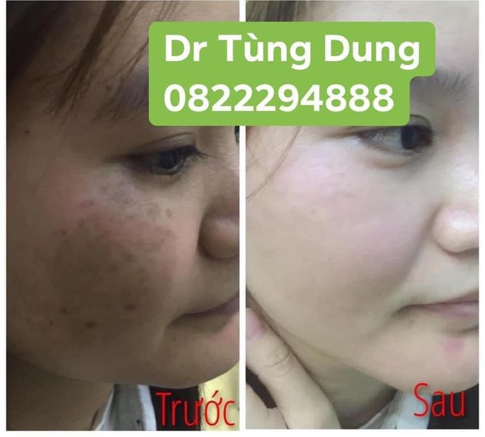 Hình ảnh quy trình điều trị chuyên nghiệp tại Thẩm Mỹ Viện Bác Sĩ Tùng Dung