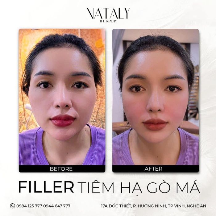 Hệ thống máy móc hiện đại và quy trình tiêm chuẩn y khoa tại KA Nataly Beauty