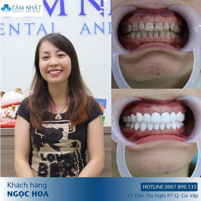 Quy trình bọc răng sứ chuyên nghiệp tại Nha Khoa Tâm Nhất