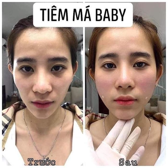 Quy trình tiêm filler chuyên nghiệp tại VÂN SPA (ảnh 2)