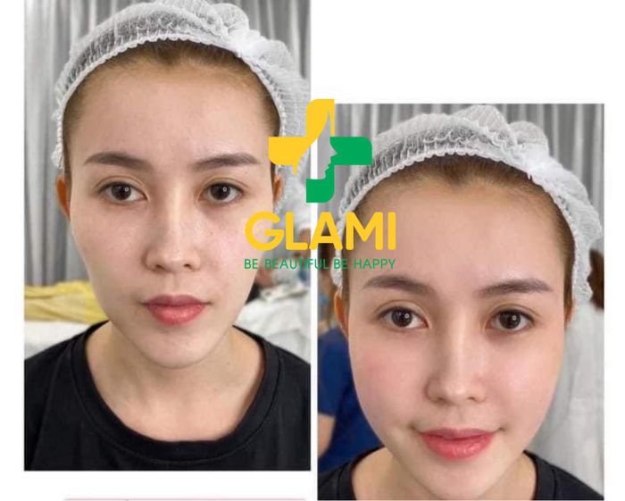 Quy trình tiêm filler chuyên nghiệp tại GLAMI 198+ (ảnh 2)
