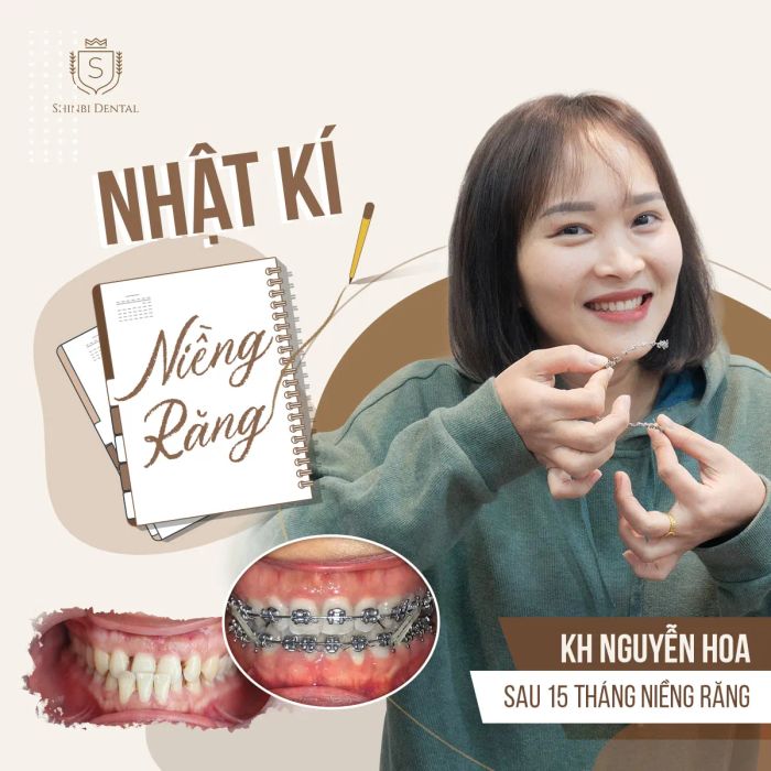 Hình ảnh quy trình chỉnh nha chuyên nghiệp tại Viện Chỉnh Nha Shinbi